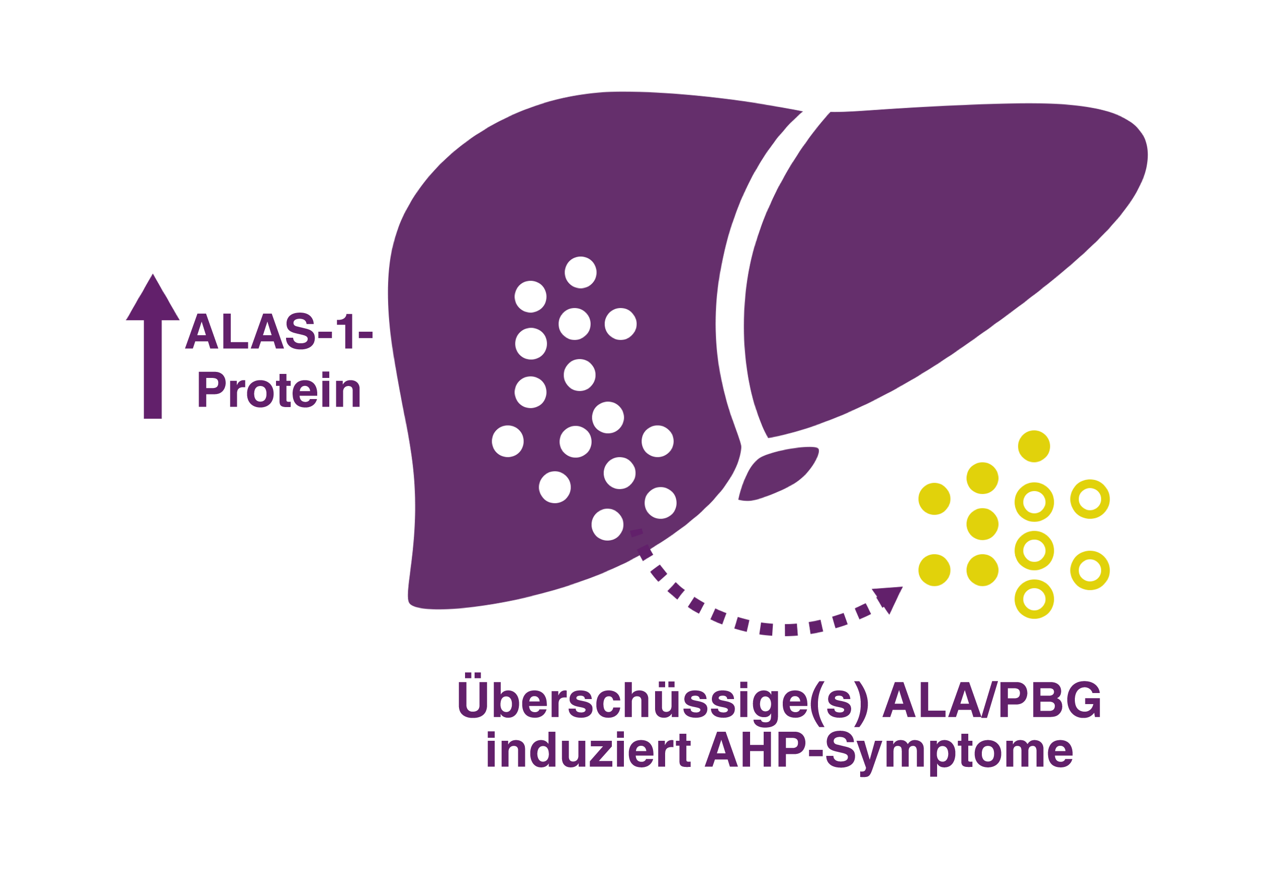 Hochregulierung von ALAS 1 ist ein zentraler pathophysiologischer Mechanismus, der der AHP zugrunde liegt